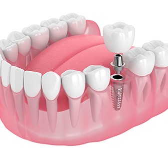Illustration of a single dental implant