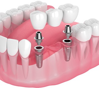 Illustration of an implant bridge