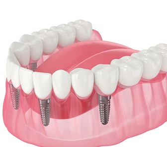 Illustration of an implant denture