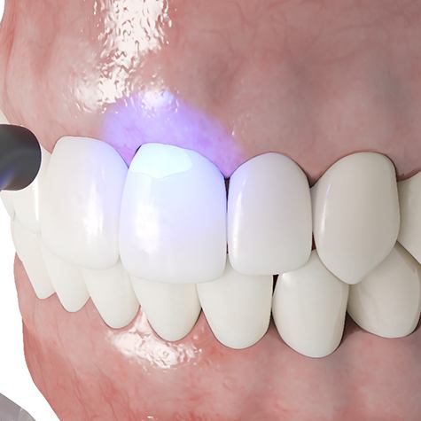 3D render of cosmetic dental bonding