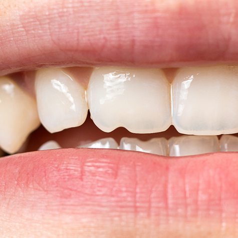 Close-up of a chipped tooth