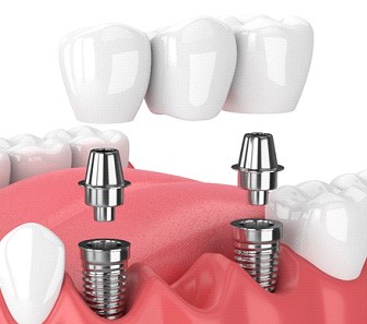 example of an implant dental bridge in McKinney 