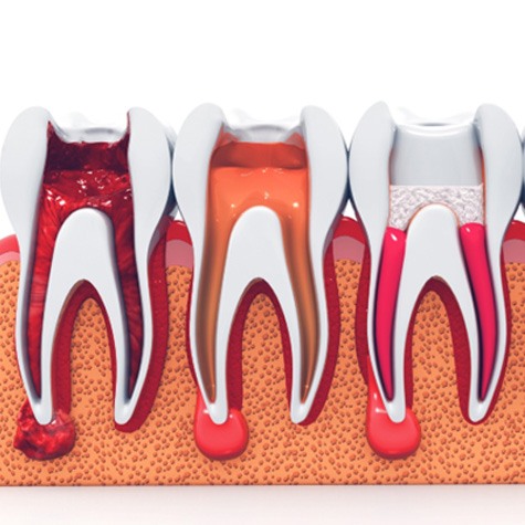 3-D model of the step-by-step process of a root canal