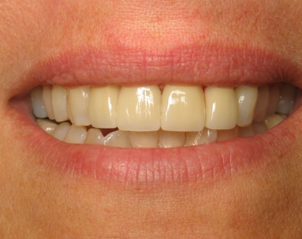 Flawless smile after dental treatment