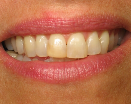 Smile with yellowed top front teeth before dental treatment
