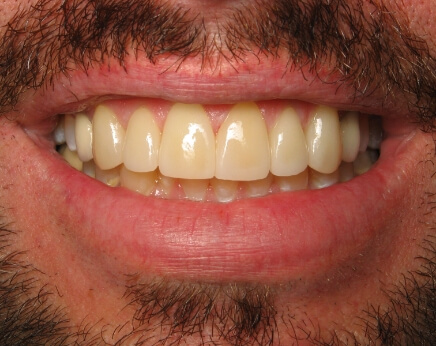 Bright white smile after teeth whitening