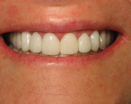 Smile after dental care