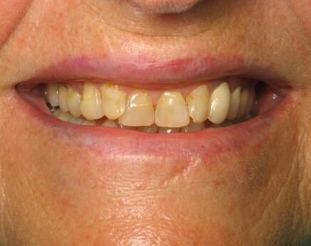 Severely yellowed and decayed teeth before dental treatment