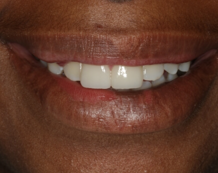 Smile with top front teeth after dental treatment
