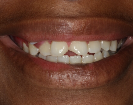 Damaged top front teeth before dental treatment