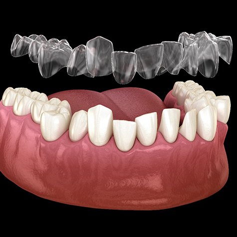 Illustration of clear aligner being placed on crooked teeth