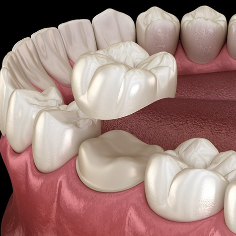 example of dental crowns in McKinney