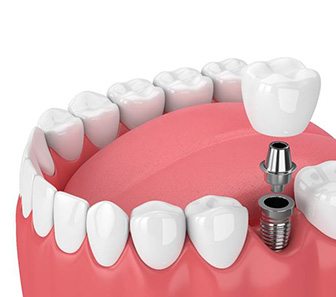 3D graphic of dental implant