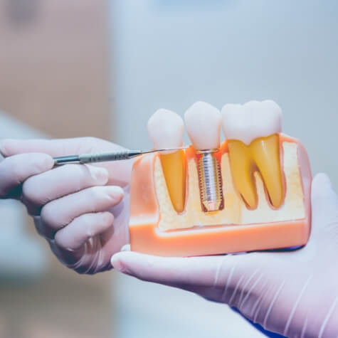 Dentist pointing to dental implant supported dental crown model