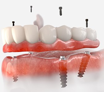 an illustration of implant dentures in McKinney
