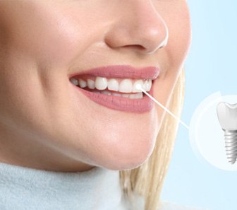 A closeup of a woman whose front tooth is an implant 