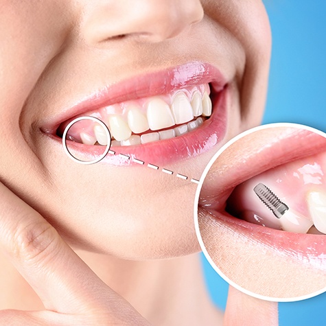 Nose-to-neck image of woman framing her chin with two fingers smiling with one tooth indicated as an implant
