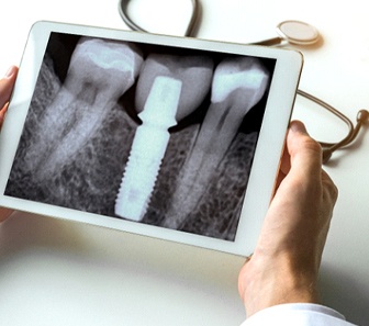 X-ray of an integrated dental implant in McKinney