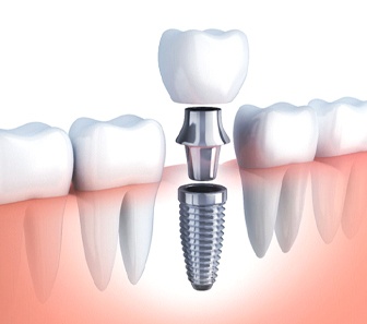 Diagram showing how dental implants in McKinney work