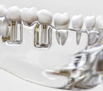 Model holding an integrated implant bridge