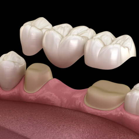 Animated smile during dental bridge placement