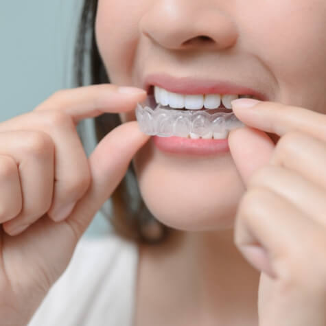 Woman placing clear correct alignment tray