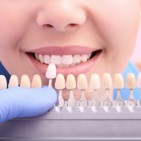 Woman's smile compared with tooth colored filling shade chart