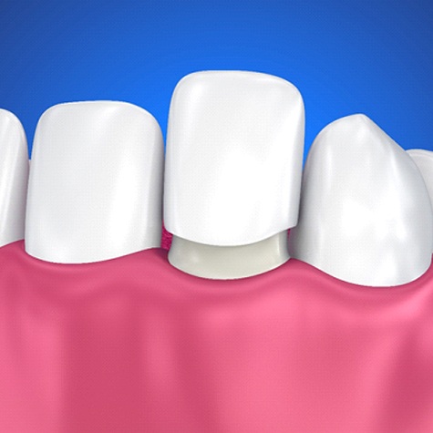 illustration of the veneer process in McKinney