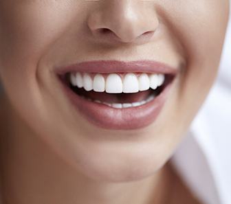 closeup smiling for cost of veneers in McKinney