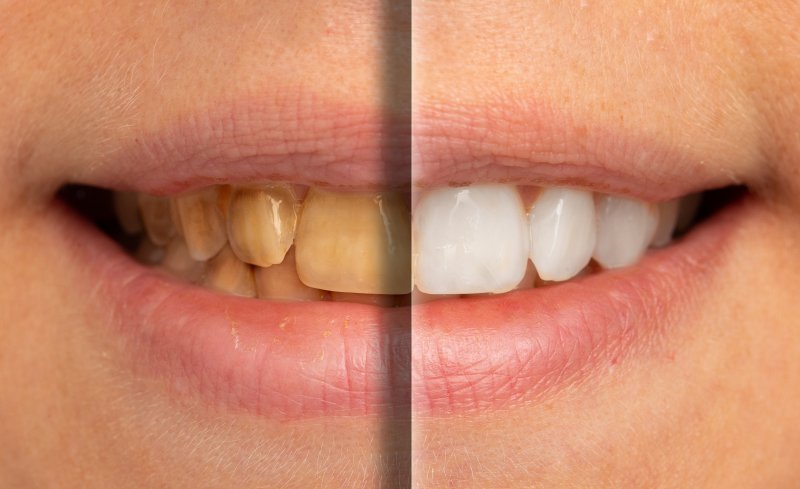 before and after of a cosmetic dental treatment