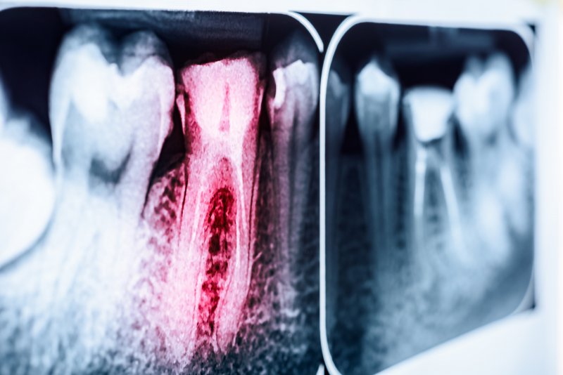red x-ray of a tooth