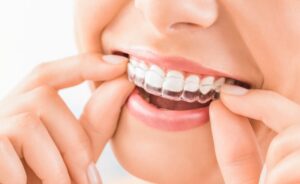 Person smiling while holding clear aligners up to their mouth.